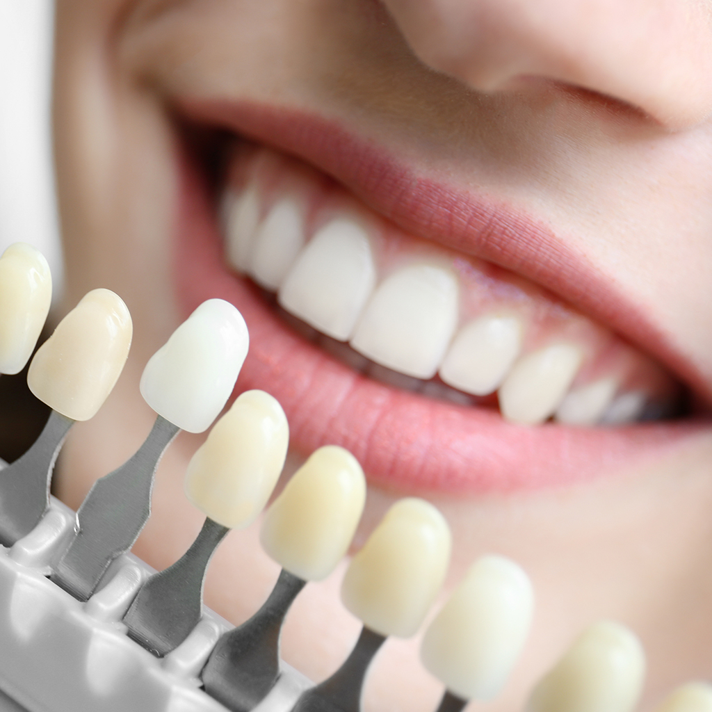 Teeth Whitening_126047877
